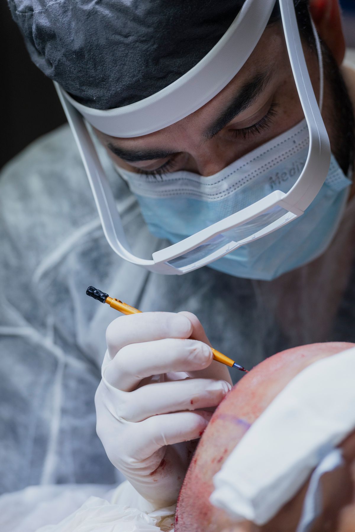 Graft Count and Density in Hair Transplant: How Are They Decided?